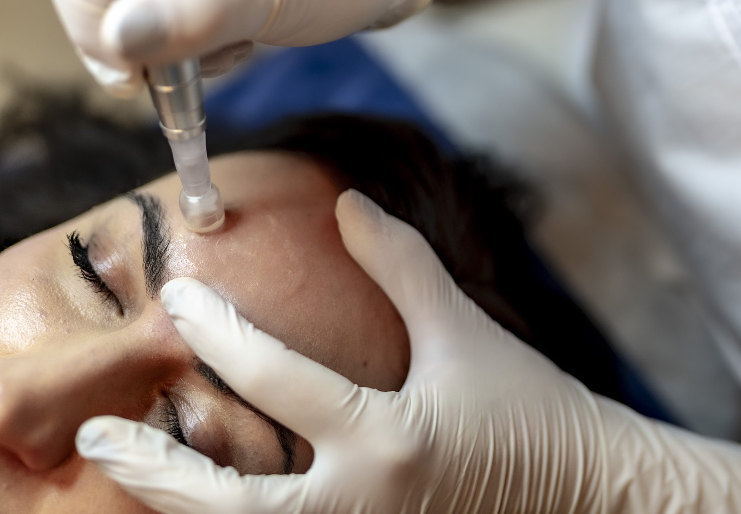 Nanoneedling Behandlungsbild